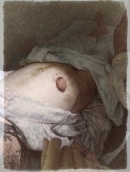 Tel's colostomy