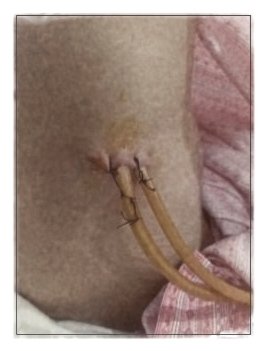 Tel's nephrostomy